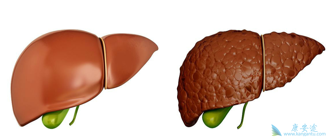 肝癌 肝癌
