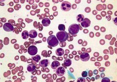 ���԰�Ѫ���ı���֢״��ʲô ��Ѫ��ϸ��Ҫ��ô����