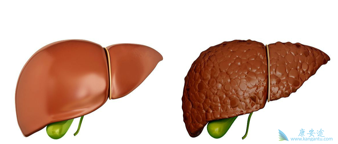 肝癌 肝癌