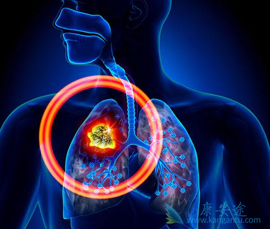 非小细胞肺癌 非小细胞肺癌