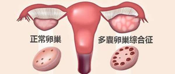 多囊卵巢综合症患者可以做试管婴儿吗