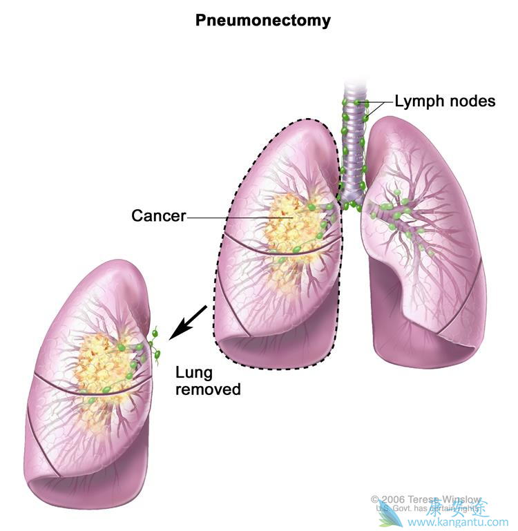肺癌的治疗方法