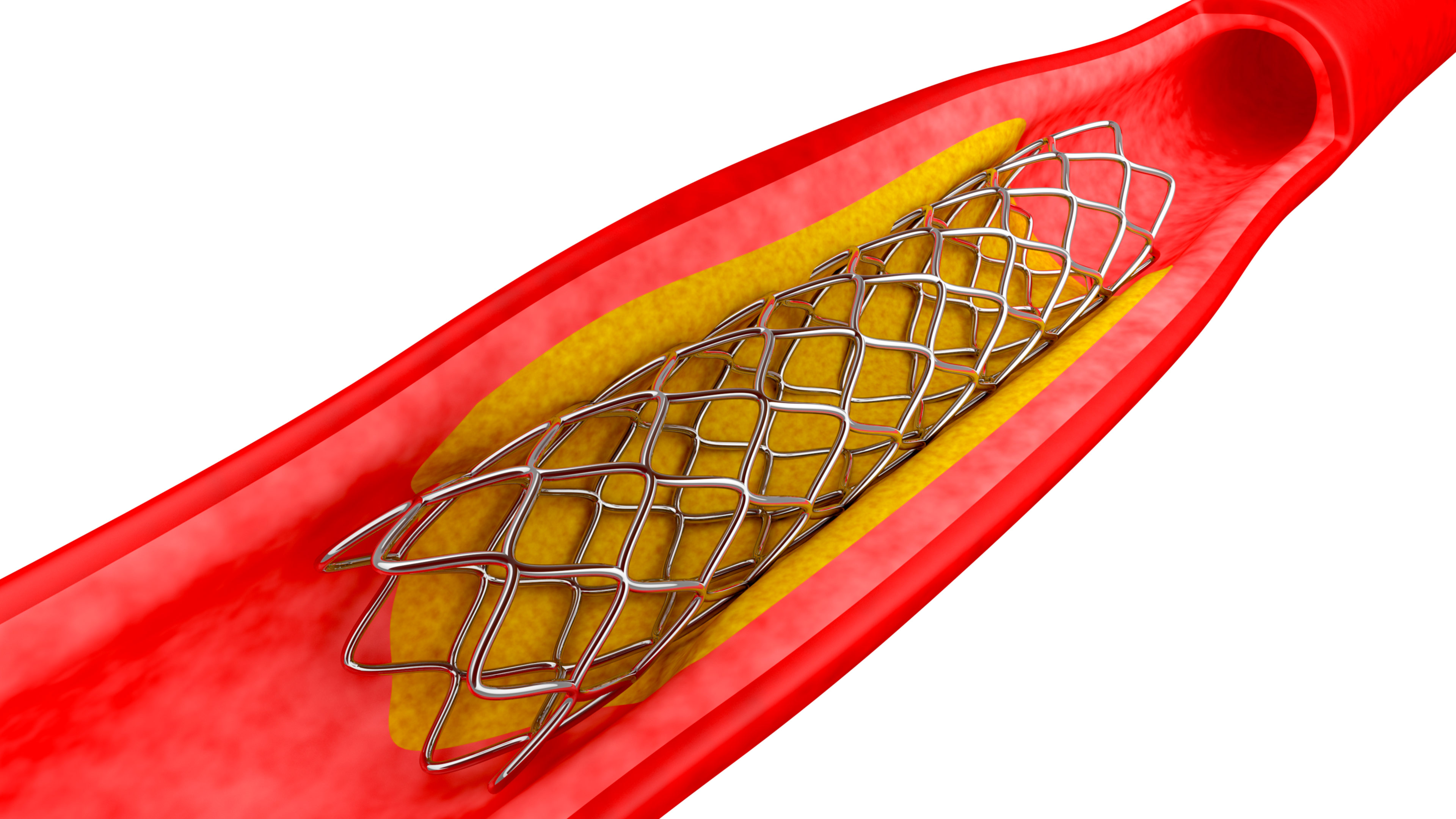 心脏主动脉支架图片