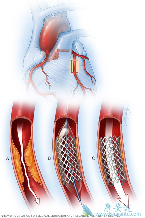 心肌梗塞手术支架图片图片