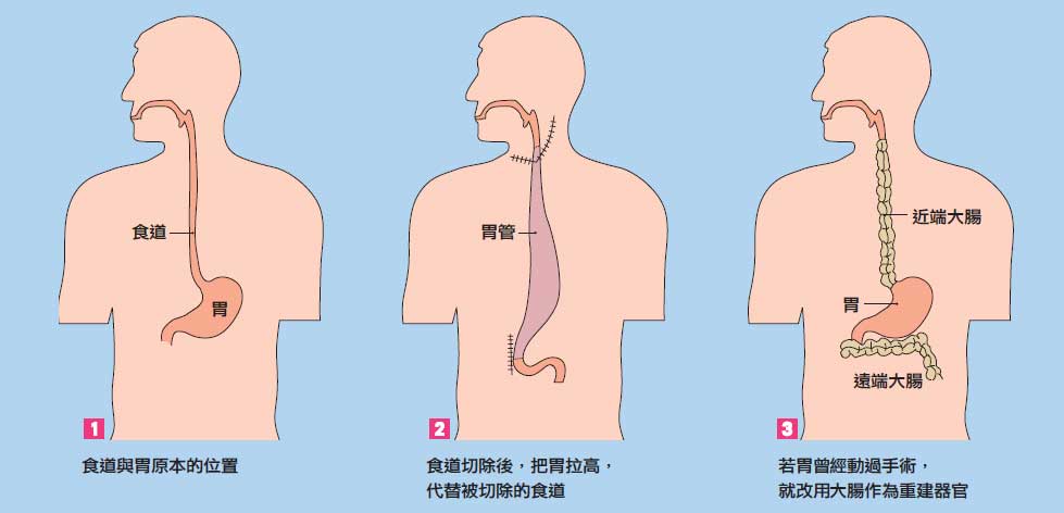 发生早期食道癌症状有哪些征兆