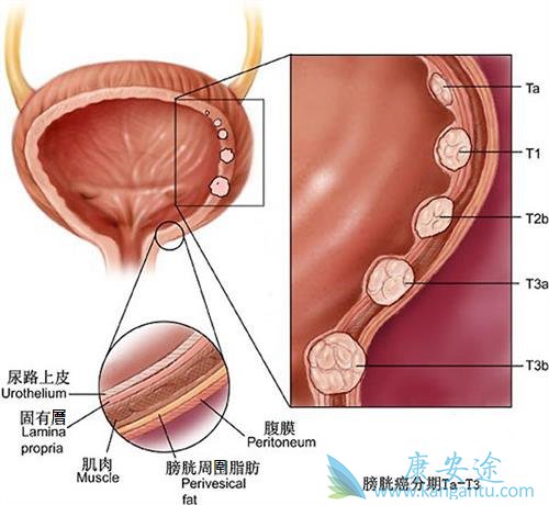 女性膀胱肿瘤早期症状图片